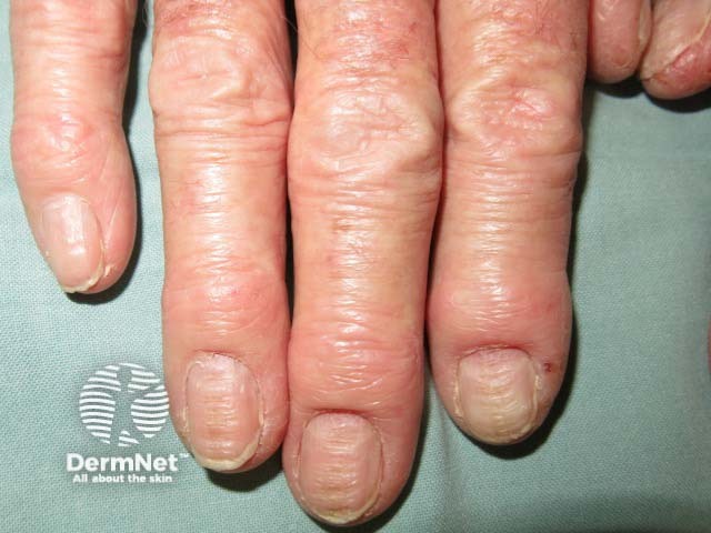 Paronychia with hand dermatitis