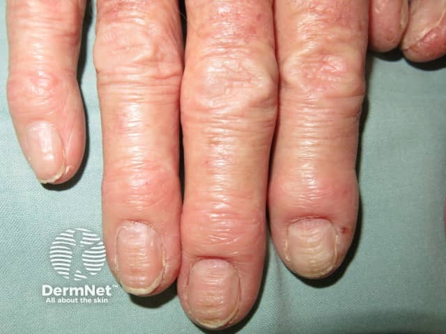 Chronic paronychia and hand dermatitis
