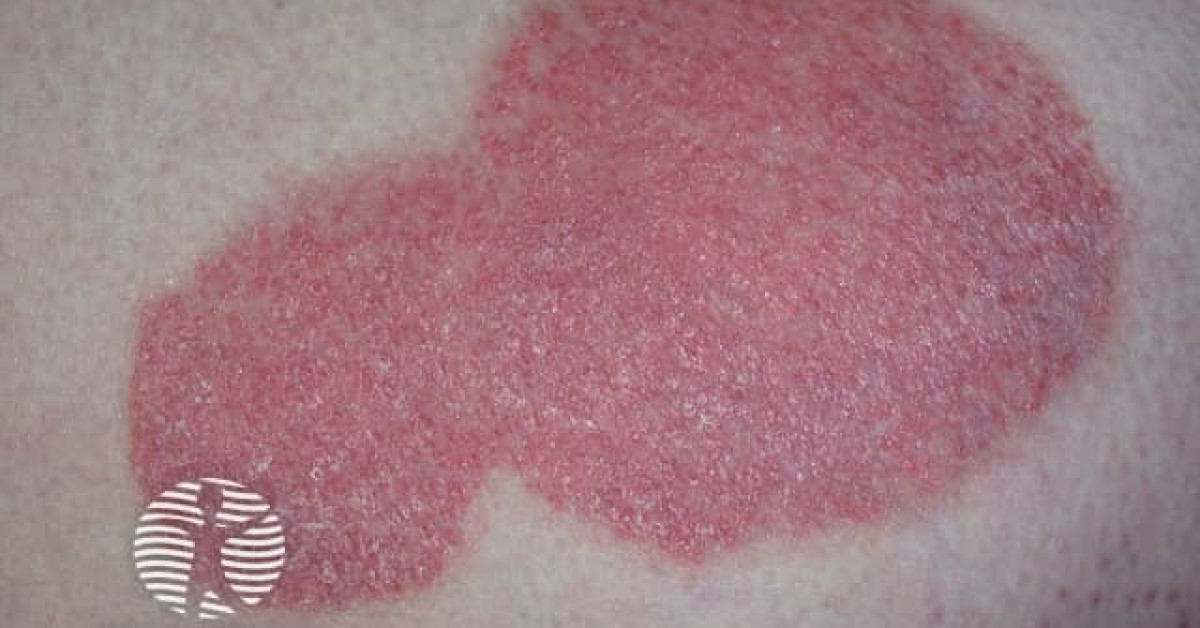 DermNet® - Chronic plaque psoriasis image