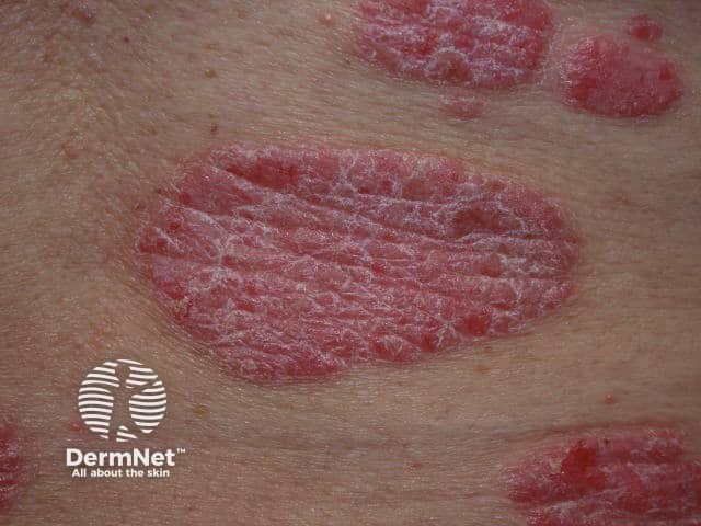 Close up of well demarcated plaques with silvery scale in chronic plaque psoriasis
