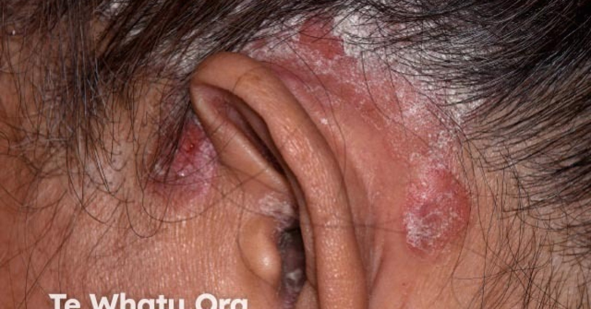 icd 10 code for chronic plaque psoriasis