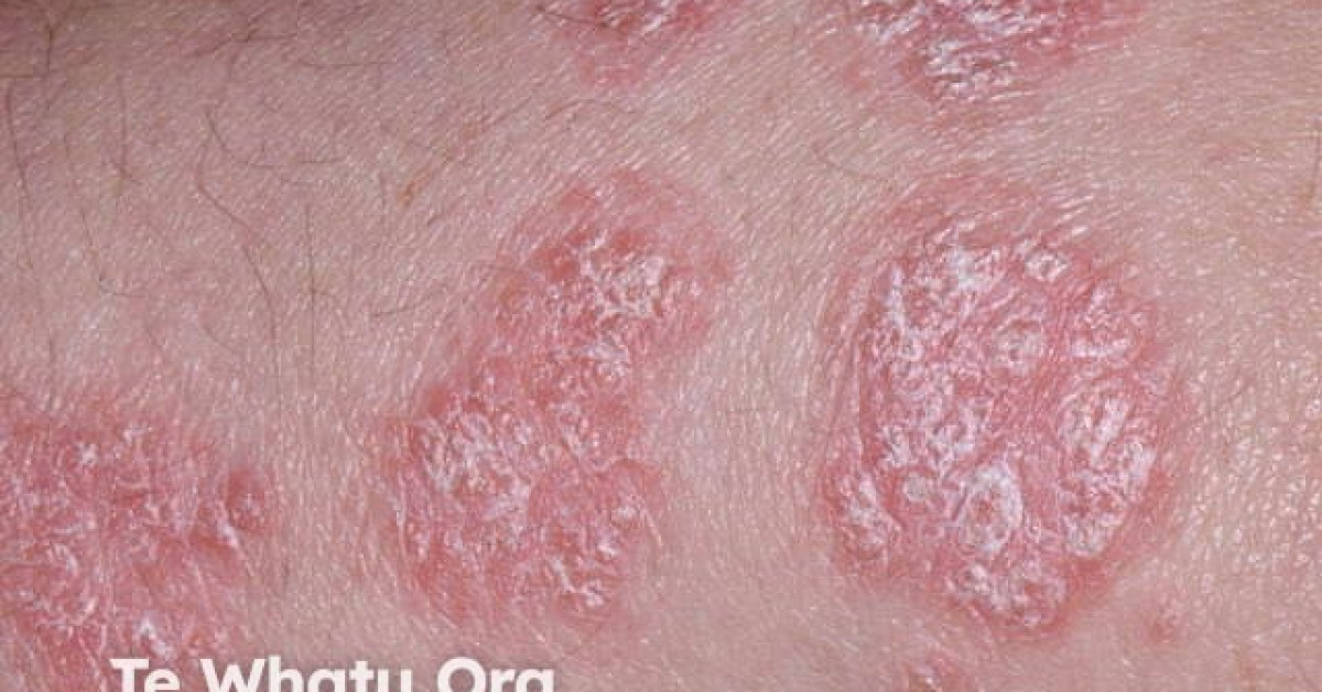 DermNet® - Chronic plaque psoriasis image