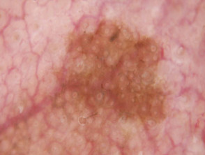 Grey concentric circles seen on dermoscopy of lentigo maligna