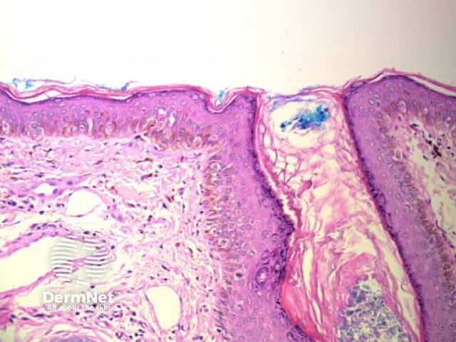 Grey circles correspond to pigmented melanocytes within follicular infundibula