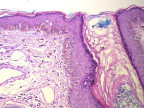 Histology of melanoma in situ