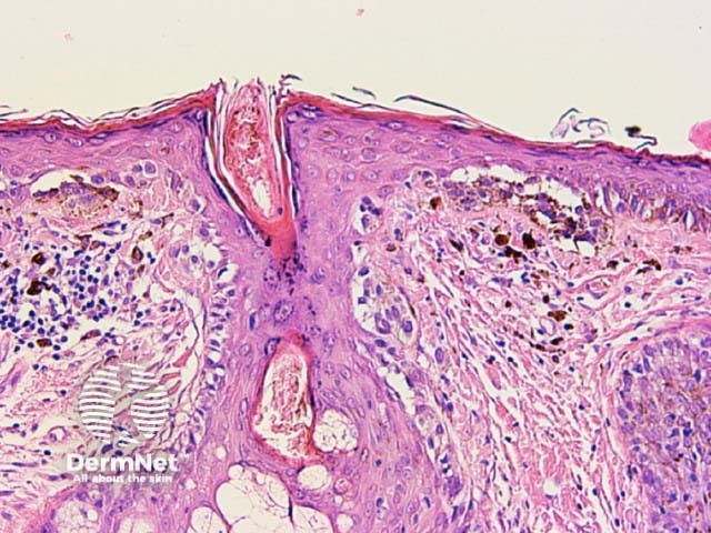 Prominent perifollicular melanophages are seen as grey dotted circles