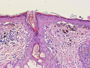 Histology of melanoma in situ