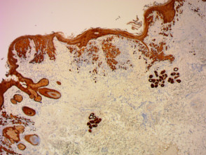 Lichen planus showing Civatte bodies on histology stained with cytokeratin x40