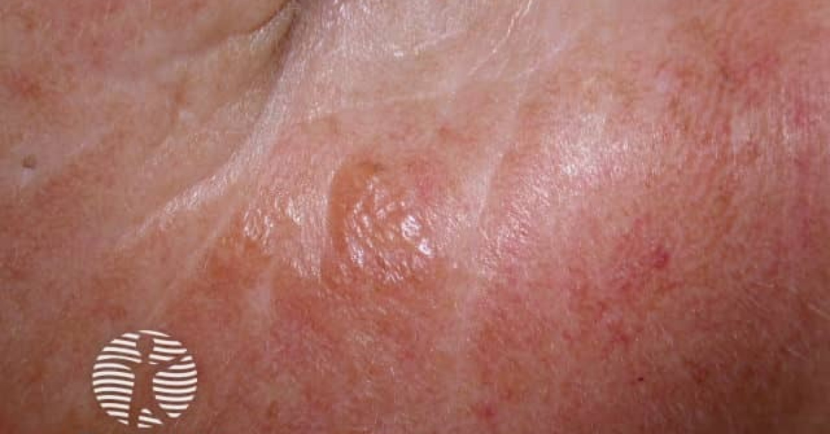 Adult colloid milium image