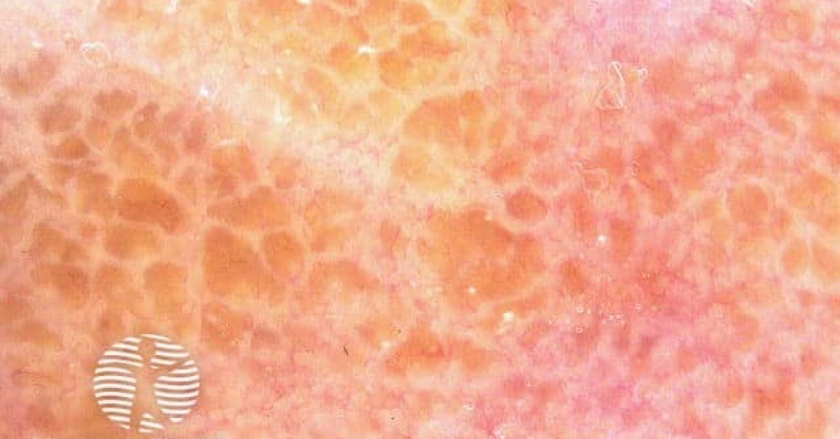 Dermoscopy of adult colloid milium image