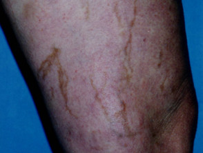 Post-sclerotherapy staining