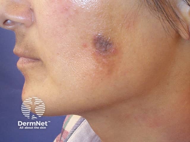 Postinflammatory hyperpigmentation (inflamed cyst)