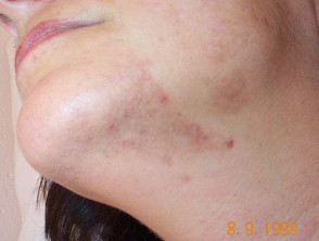 Postinflammatory hyperpigmentation due to acne