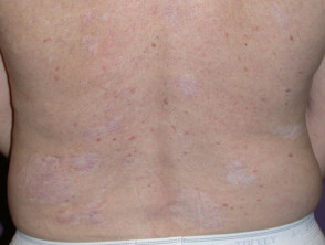 Postinflammatory hypopigmentation: Surgery and cryotherapy to multiple skin cancers