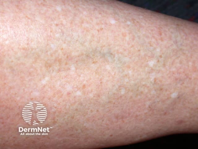 Idiopathic Guttate Hypomelanosis Idiopathic Guttate Hypomelanosis