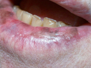 Lichen planus pigmentosus of lower lip