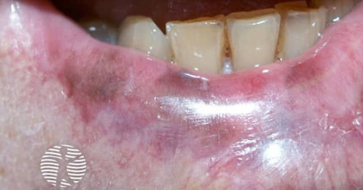 Pigmented contact cheilitis image