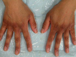 Postinflammatory pigmentation. Irritant dermatitis