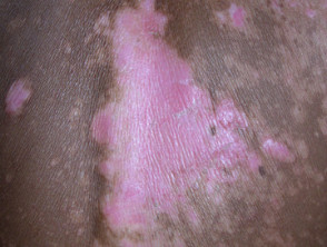 Sunburn in vitiligo
