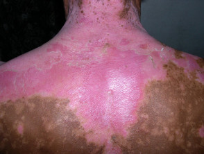 Sunburn in vitiligo