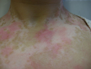 Vitiligo with phototoxicity
