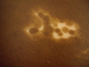 Trichrome vitiligo