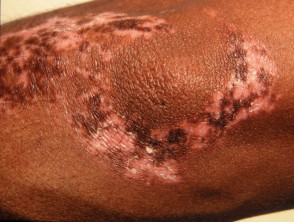 Trichrome vitiligo
