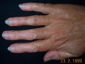 Acral vitiligo