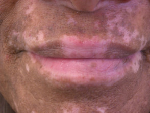 Mucosal vitiligo