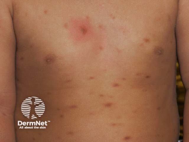 Cutaneous mastocytosis in an infant - yellow-brown macules over the chest and back. The chest lesion has urticated 5 minutes after rubbing (Darier sign)