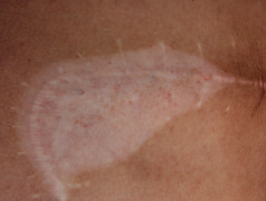 Koebnerised vitiligo