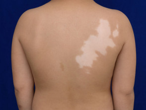 Segmental vitiligo