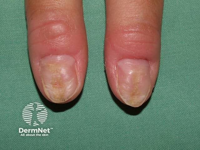 Nail dystrophy due to compulsive picking