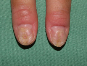 Nail dystrophy due to compulsive picking