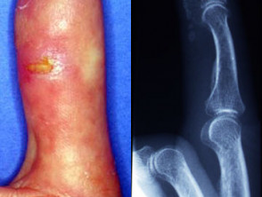 Calcinosis cutis in systemic sclerosis