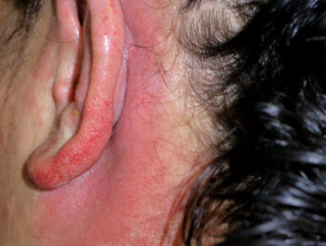Paraphenylenediamine and hair dye contact allergy | DermNet