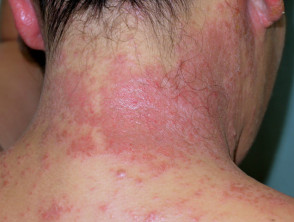 Allergic contact dermatitis to hair dye