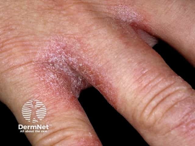 Hand dermatitis due to excessive exposure to water