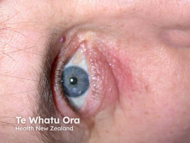 Airborne contact dermatitis eyelid
