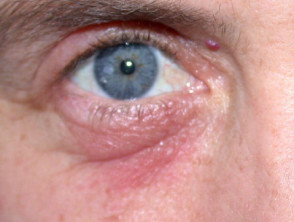 Airborne contact dermatitis eyelid
