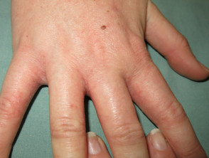 Contact dermatitis due to isocyanate