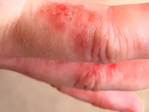 Contact dermatitis due to isocyanate