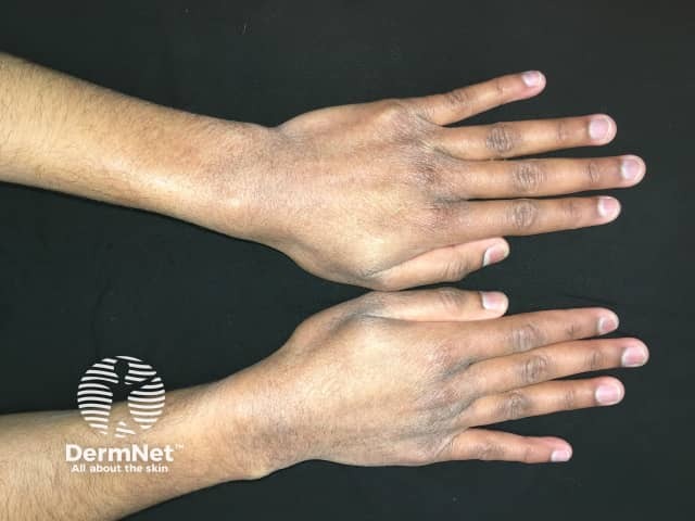 Contact dermatitis due to hand washing