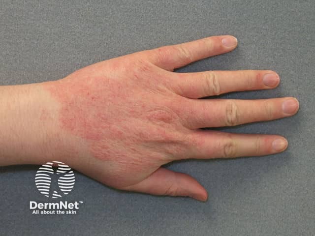 Contact dermatitis due to washing