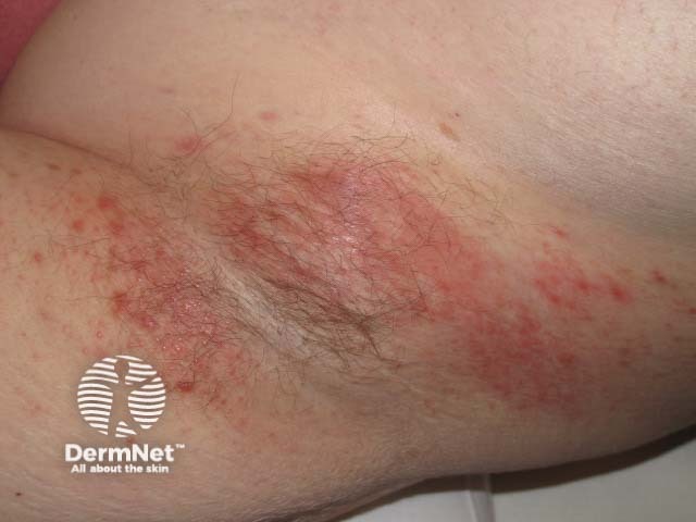 Contact dermatitis causing intertrigo