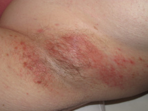 Contact dermatitis due to clothing dye allergy