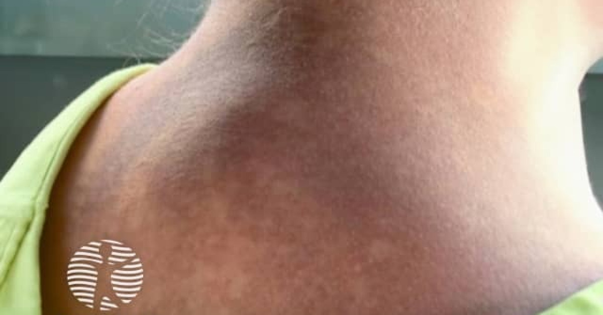 Suspected COVID-19 rash image