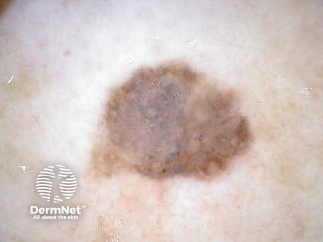 Melanoma in situ, nonpolarised dermoscopy view