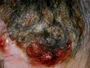 Eczematous infected plaque in Hodgkin lymphoma