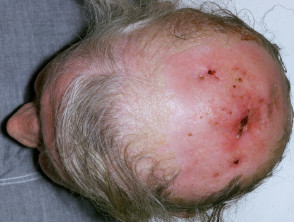 Excoriations in Hodgkin lymphoma